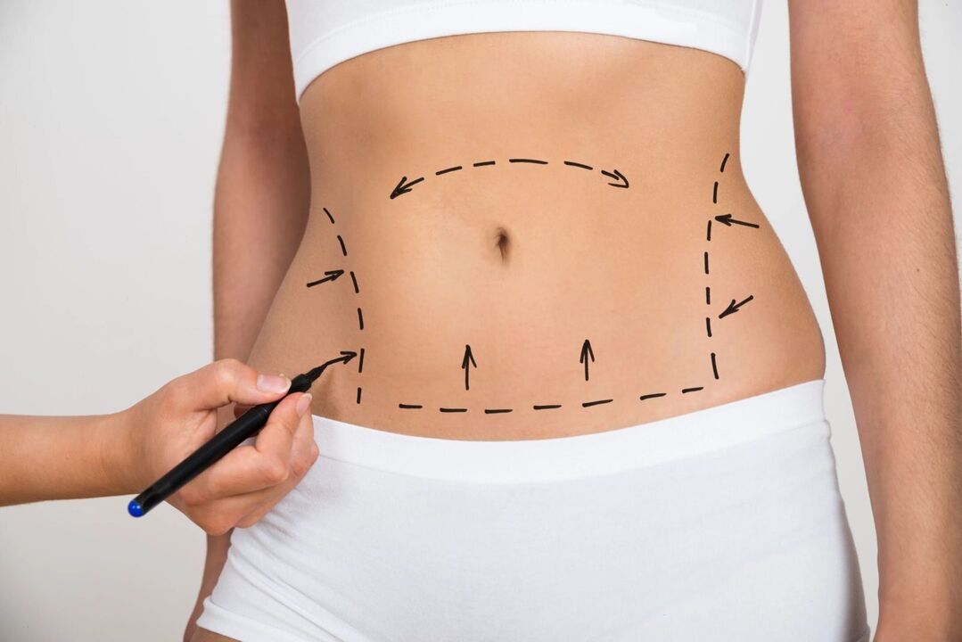 Mark the abdomen before liposuction to correct the figure